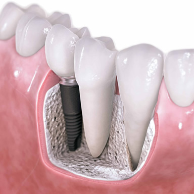 Implantes Dentários