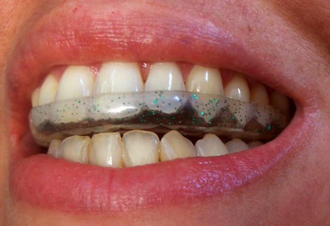 Aparelhos para Bruxismo  e ATM