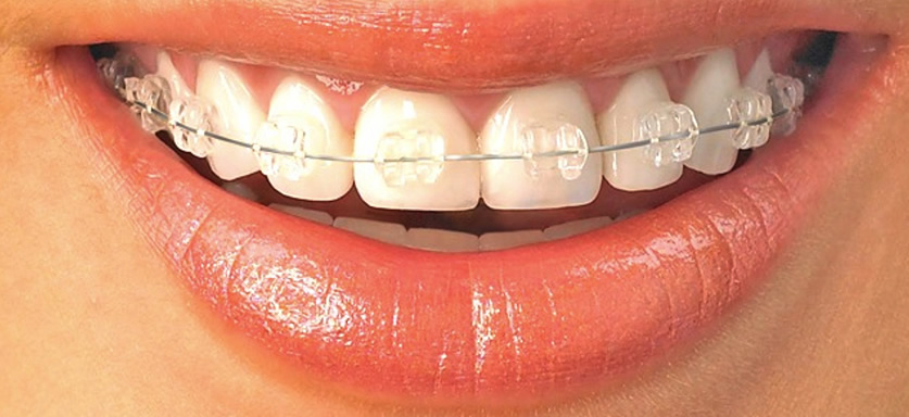 Aparelhos Cerâmicos