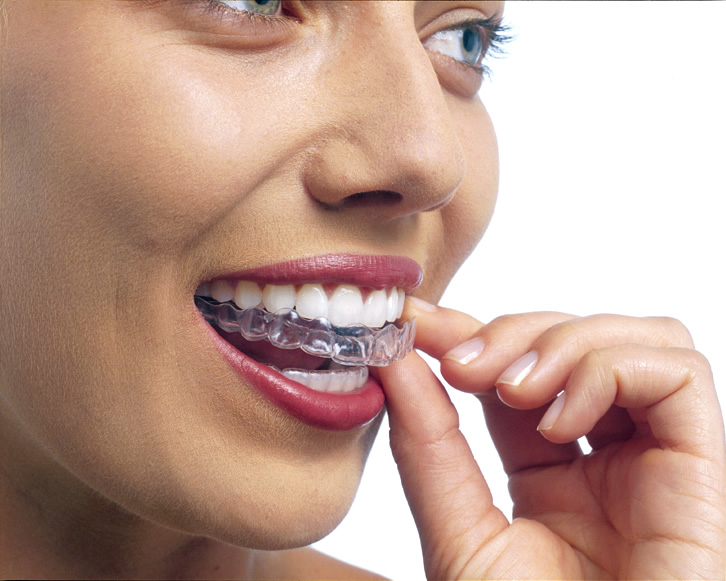 Aparelhos Invisíveis - Invisalign®